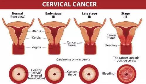cervical cancer and HPV